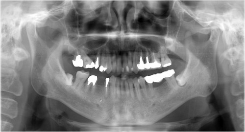 張１　初診時　◎